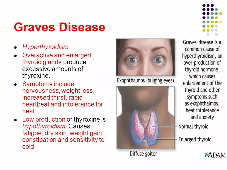 The Connection Between Graves' Disease and Neuropathy