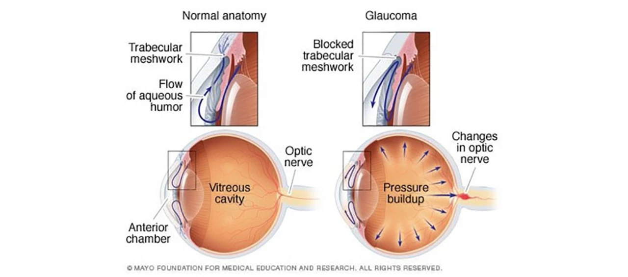 The Relationship Between Open-Angle Glaucoma and Dry Eye Syndrome